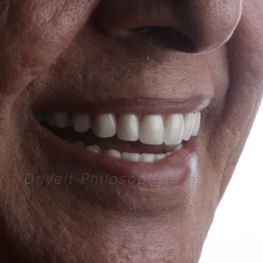 https_drveit.com.br_casos-clinicos_reabilitacao-oral-com-implantes-zigomaticos-7__5