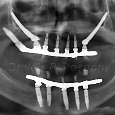 https_drveit.com.br_casos-clinicos_reabilitacao-oral-com-implantes-zigomaticos-7__7