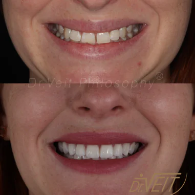 https_drveit.com.br_casos-clinicos_reabilitacao-oral-com-lentes-de-contato-2__10