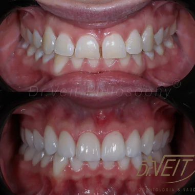 https_drveit.com.br_casos-clinicos_reabilitacao-oral-com-lentes-de-contato-2__12