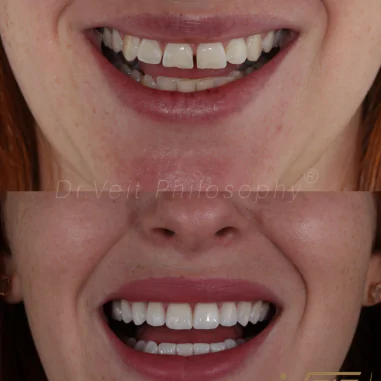 https_drveit.com.br_casos-clinicos_reabilitacao-oral-com-lentes-de-contato-2__5