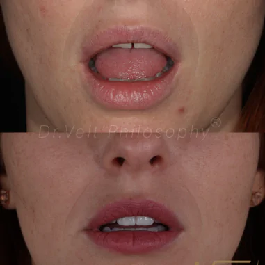 https_drveit.com.br_casos-clinicos_reabilitacao-oral-com-lentes-de-contato-2__7