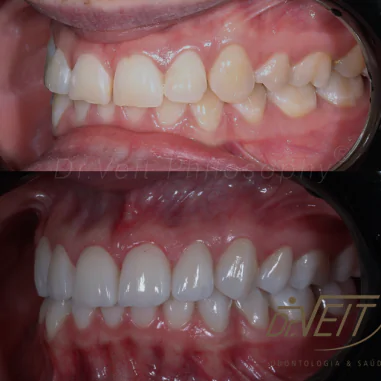 https_drveit.com.br_casos-clinicos_reabilitacao-oral-com-lentes-de-contato-2__9